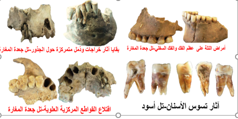 آثار أمراض خبيثة1
